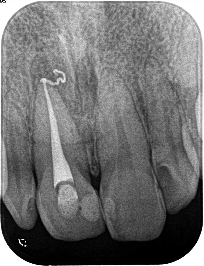 右上中切歯右上前歯の垂直加圧根管充填した後のレントゲン写真