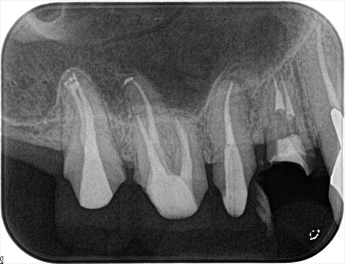 右上第一小臼歯のメタルコアを除去して再根管治療を行いました。2022.09.06