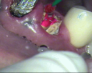 ボロボロになっている右上犬歯の虫歯を染めているGIF動画
