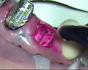 ボロボロになっている右上犬歯の虫歯を染めて水洗しているGIF動画