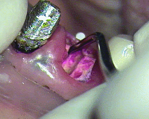 ボロボロになっている右上犬歯の虫歯を染めて除去しているGIF動画