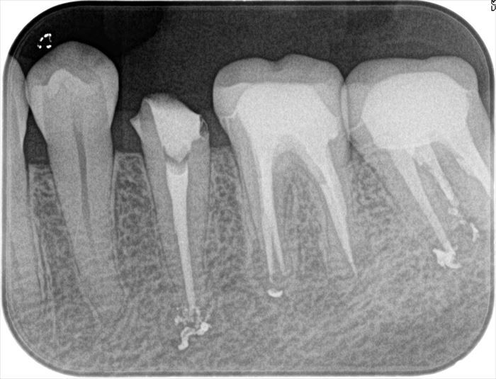 左下第二小臼歯の再根管治療を行いました。2022.10.12