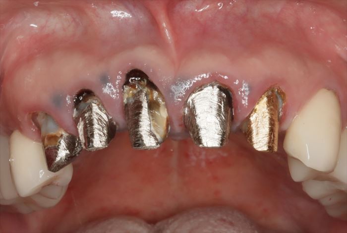 ボロボロになっている上顎前歯をこれから治療する金属刺青・メタルコアが多数存在している写真