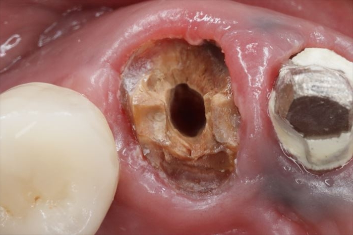 右上犬歯の象牙質が虫歯によって朽ちてボロボロになっている写真