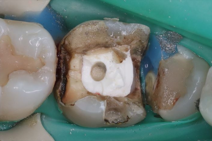 右下第一大臼歯の金属を除去した内部の状態です。2022.10.11
