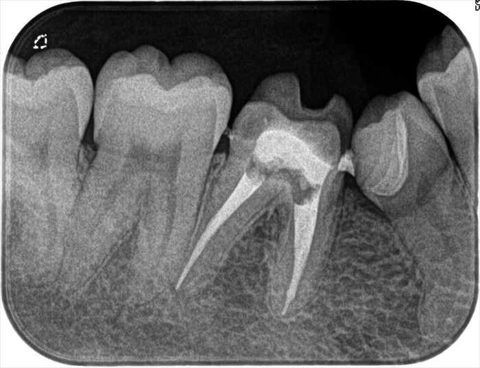 右下第一大臼歯の再根管治療を終えました。2022.10.26