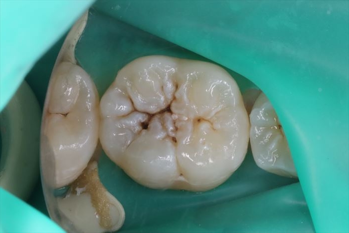 右下第一大臼歯の裂溝のむし歯をコンポジットレジン充填しました。2022.11.19