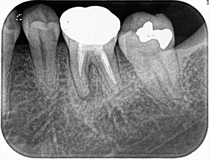 ヤスリの残っていた左下第一大臼歯の根管充填を終えました。2022.12.06｜失敗の再治療｜広島
