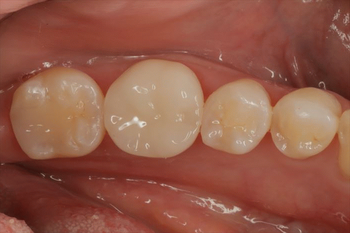 左下第一大臼歯の再根管治療・異物除去・セラミック修復を終えました。2022.12.20