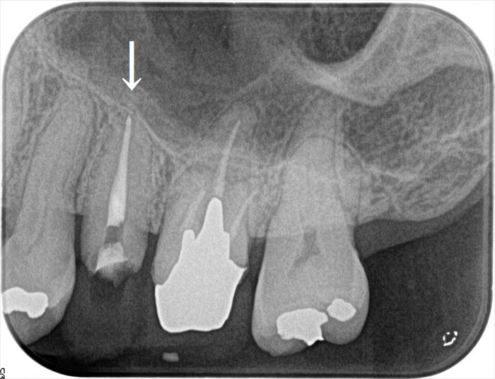 左下第二小臼歯の再根管治療を終えました。2023.01.20 ｜やり直し｜広島