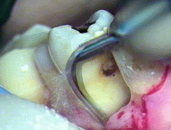 左上第一小臼歯にエムドゲイン®︎を用いた歯周病再生治療を行いました。2023.01.11｜広島