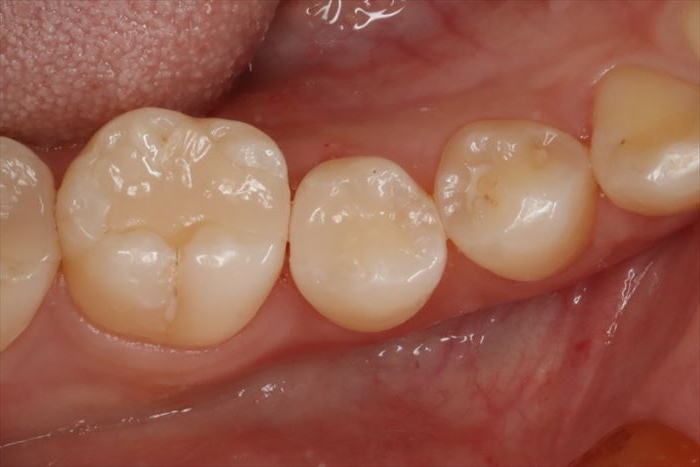 古いコンポジットレジンの内部がむし歯になっていました。右下第二小臼歯 2023.01.14｜広島｜セラミック治療