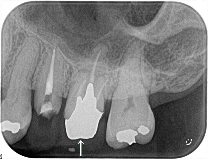 左上第一大臼歯にメタルコアが入っている状態のレントゲン写真