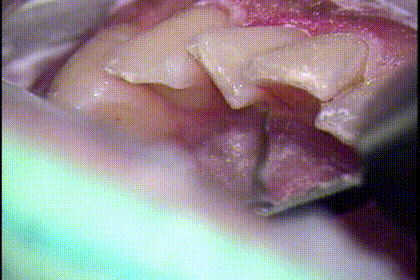 下顎前歯の歯石除去のわかりやすい動画です。2023.02.11｜歯のクリーニング｜広島