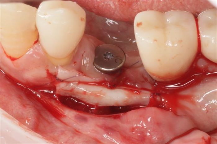 左下小臼歯インプラント部分に遊離歯肉移植しました。2023.02.02｜広島