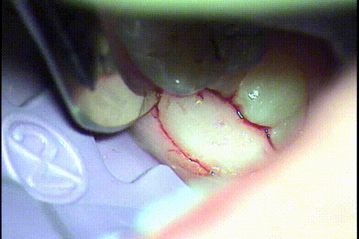 未萌出の永久歯にかぶっている歯肉を切除するgif動画