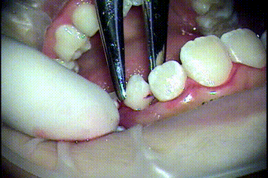 左上乳犬歯の抜歯gif動画