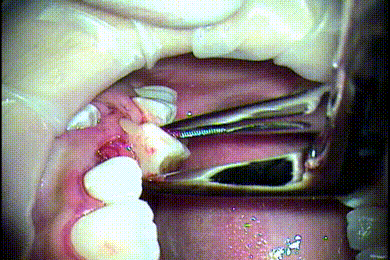 左上第一乳臼歯の抜歯gif動画