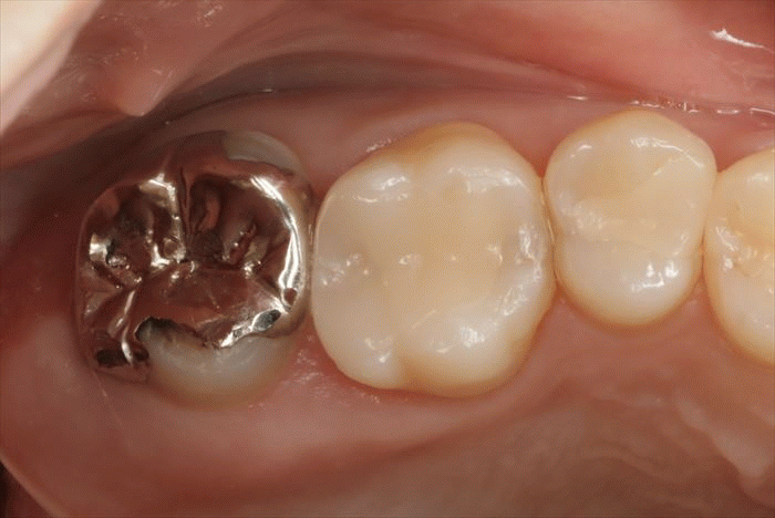 右上第二大臼歯の金属を除去したら内部はむし歯になっていました。2023.03.11｜ひどい虫歯｜広島