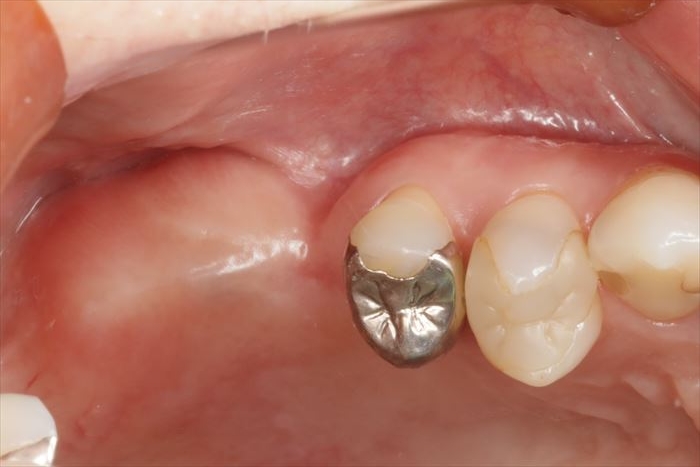 右上第一大臼歯を抜歯後骨吸収が起こり、骨の幅が狭くなっていることがよくわかる写真