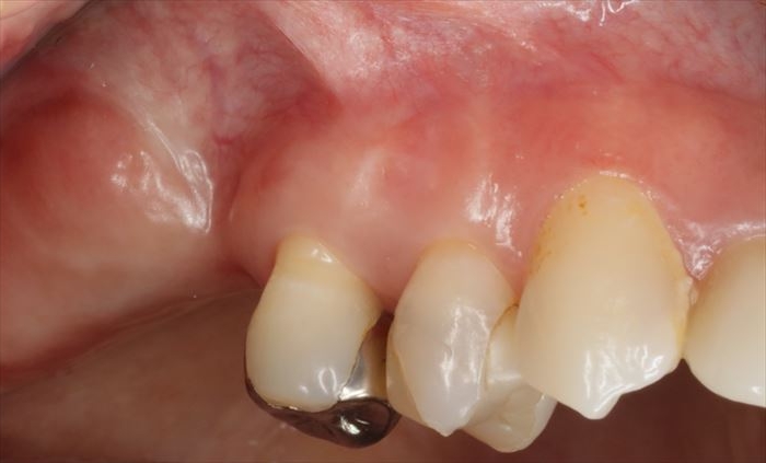右上第一大臼歯を抜歯後骨吸収が起こり、骨の幅が狭くなり高さ低くなっていることがよくわかる写真