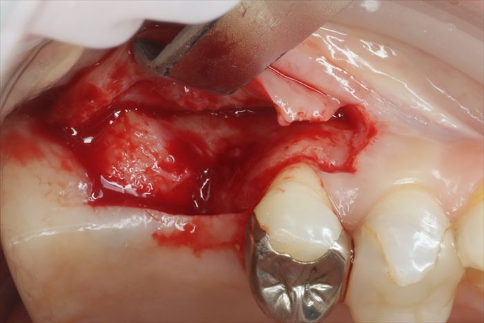 右上第一大臼歯を抜歯後骨吸収が起こり、粘膜を切開し剥離すると骨の幅が狭くなっていることがよくわかる写真