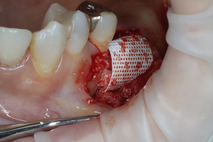 骨吸収部分に骨移植材を填入し、サイトプラスト膜（メンブレン）でカバーして縫合前の状態の写真