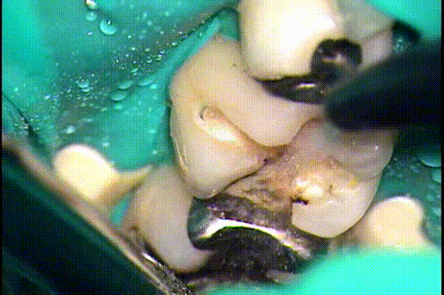 金属の内部で汚染されていた象牙質やセメントが取れるgif動画