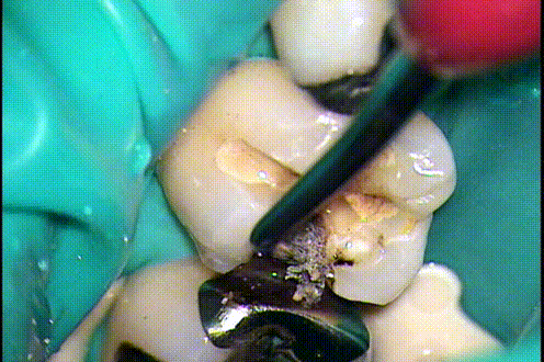 軟化象牙質をエキスカベータで取り除くgif動画