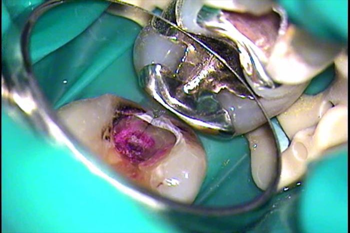 むし歯によって歯にヒビが入っている左下第一大臼歯