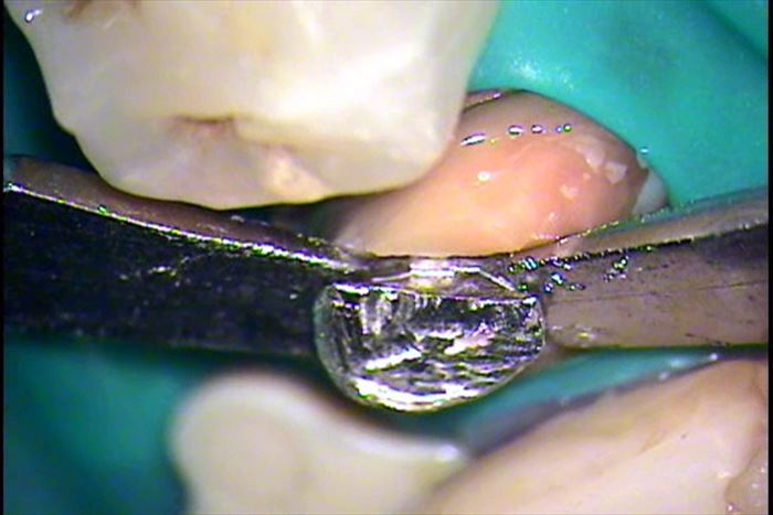右下第二小臼歯の内部に入っているメタルコアをドライバー２本で慎重に浮かしている場面の写真
