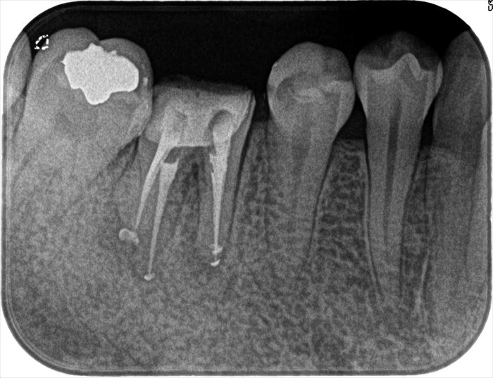ドクドク膿が出ていた右下第一大臼歯の根管充填を行いました。2023.04.13｜抜かない治療｜広島
