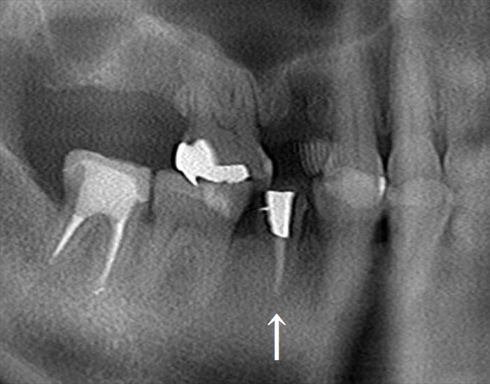 クサビのようにメタルコアがセットされている右下第二小臼歯のレントゲン写真