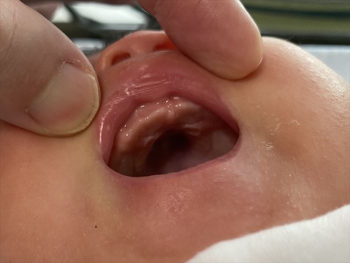 生後2か月の娘の上顎の歯ぐき