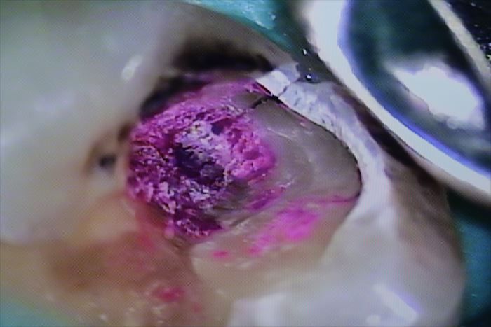 むし歯によって歯にヒビが入っている左下第一大臼歯のアップ画像