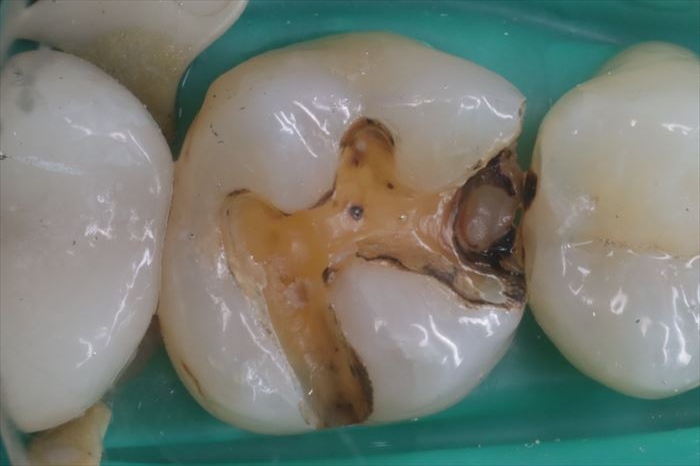 金属の内部の汚染と隣の歯のむし歯｜右上第一大臼歯のセラミック治療 2023.04.12
