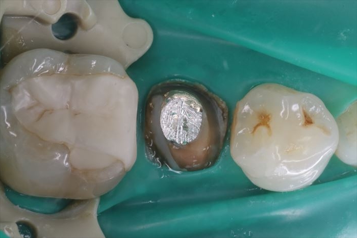 右下第二小臼歯の内部に入っているメタルコアの上面が見えている写真