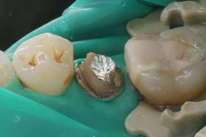 かぶせものを除去した周囲に歯石がついていた右下第二小臼歯の内部に入っているメタルコアが良く見える写真