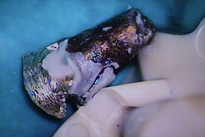 内面がとても汚染されているメタルコアの顕微鏡画像・マイクロスコープ画像