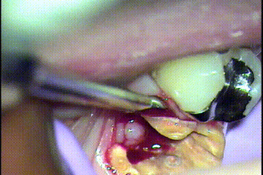 抜歯しようとヘーベルで動かすとボロボロのむし歯になった軟化象牙質がゴムの様に動くGIF動画