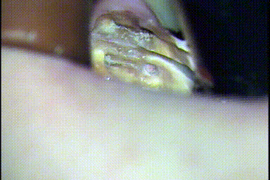 3根性の左下第一大臼歯を歯根分割抜歯するため、近心根と遠心2根をドリルで切削して分割するGIF動画