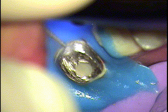 金属切削片が歯の周りの歯肉に触れないように養生保護をしてメタルコアと歯質の間に切れ目を入れる場面のGIF動画