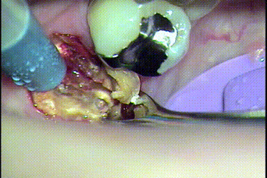 左下第一大臼歯を歯根分割抜歯して近心根をヘーベルで動かして抜歯する準備をするGIF動画