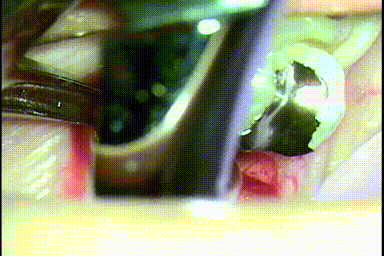 左下第一大臼歯を歯根分割抜歯して近心根を抜歯する瞬間のGIF動画