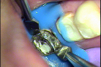メタルコアと歯質の間に入れた切れ目にドライバー形状の器具を入れて動かしメタルコアを除去する場面のGIF動画