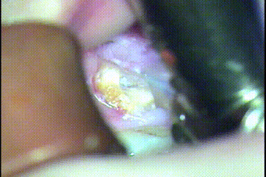 3根性の左下第一大臼歯の遠心2根をドリルで歯根分割するGIF動画