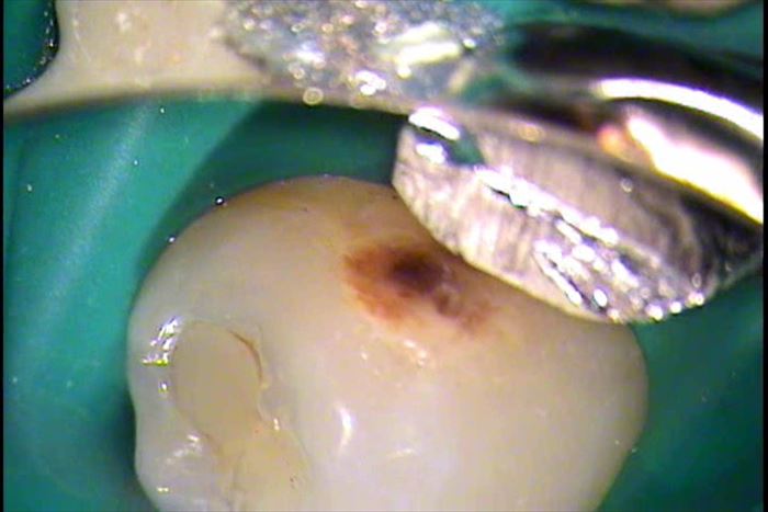 金属と接していた歯の表面がむし歯になっている写真