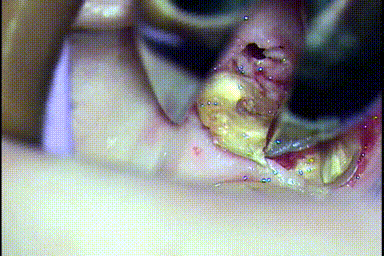 左下第一大臼歯を歯根分割抜歯して遠心頬側根を抜歯する瞬間のGIF動画