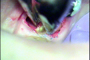 左下第一大臼歯を歯根分割抜歯して湾曲している遠心舌側根を抜歯する瞬間のGIF動画