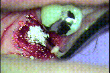 抜歯と同時にすべき処置は？｜むし歯が進行していた左下第一大臼歯の抜歯と骨増生処置 2023.04.29｜広島